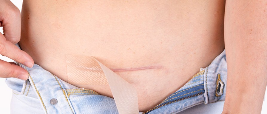 Estetik Ameliyatlarda İz Kalır mı? İzleri Azaltmak için Öneriler