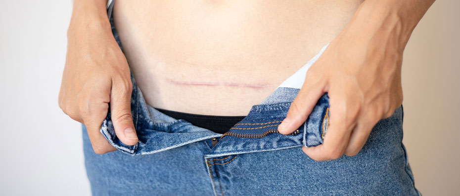 Estetik Operasyon Sonrası İzlerin Azaltılması İçin Önemli Tavsiyeler