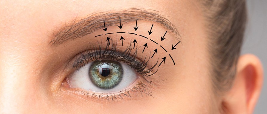 Heilungsverlauf nach einer Lidstraffung (Blepharoplastik): Was ist zu erwarten?