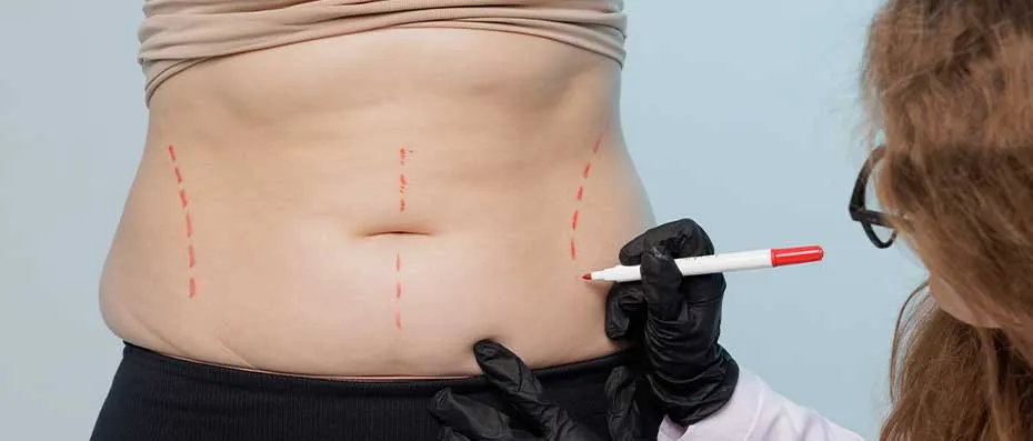 Abdominoplasty Techniques and Their Results