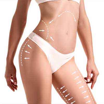 Yağ Aldırma (Liposuction)