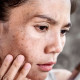 Yüzdeki Lekeler ve İzler İçin Uygulanan Estetik Tedaviler Nelerdir?