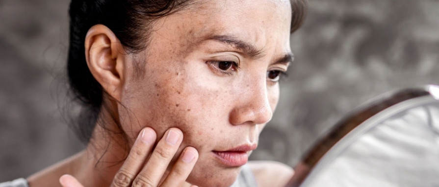 Yüzdeki Lekeler ve İzler İçin Uygulanan Estetik Tedaviler Nelerdir?