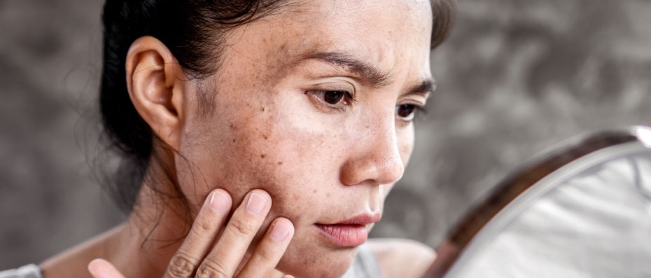 Yüzdeki Lekeler ve İzler İçin Uygulanan Estetik Tedaviler Nelerdir?