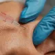 Yüze Yağ Enjeksiyonu ile Doğal Bir Gençleşme Mümkün mü?